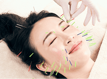お試しオーロラ美鍼コース